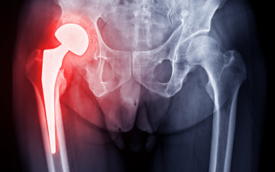 Bikini Incision Anterior Hip Replacement Surgeon in Knoxville, TN