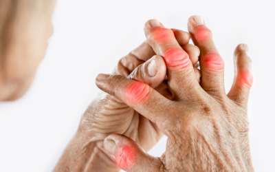 How Can I Reverse My Arthritis?